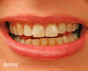 Blanqueamiento dental- Antes